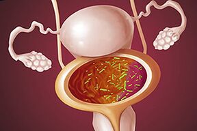 Bakteriálna cystitída u ženy